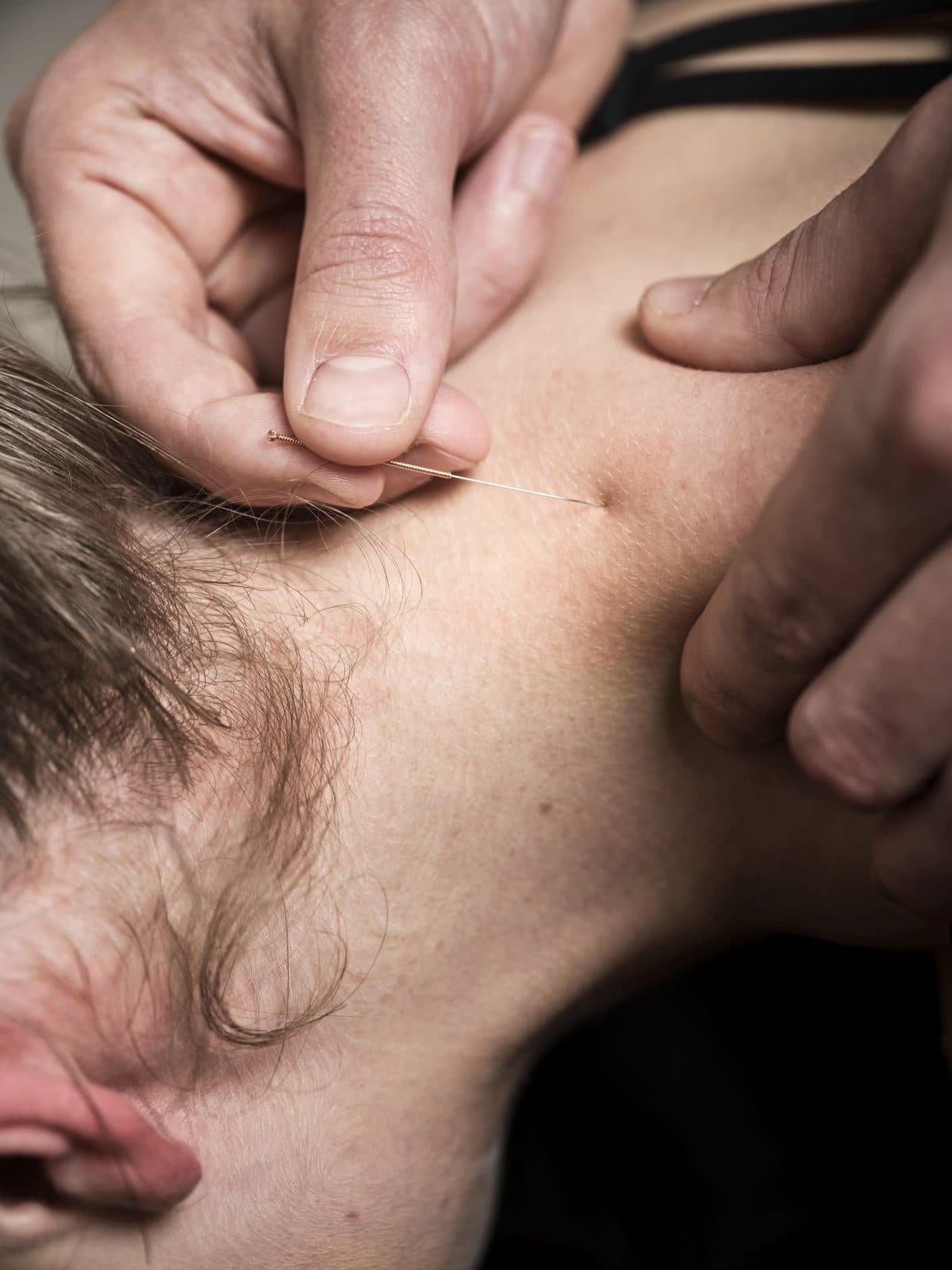 Dry needling at Matrix Health & Performance in Ivanhoe East